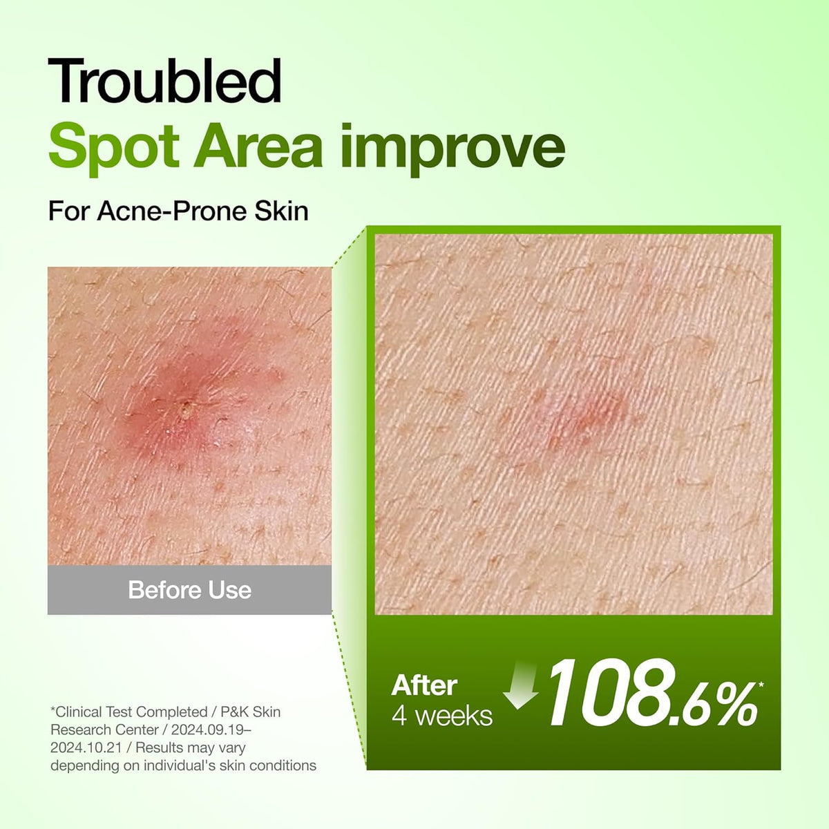 Before and after close-ups of a blemish-prone cheek showing a 108.6% improvement in the troubled spot area after four weeks