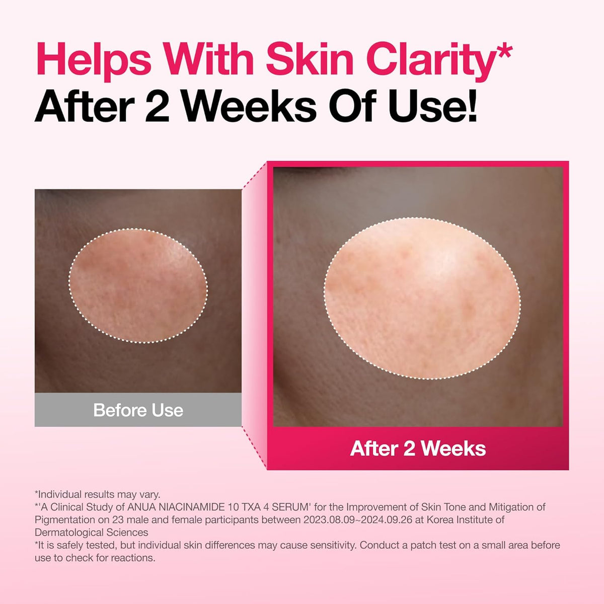 Before and after cheek close-ups showing improved skin clarity after two weeks of use
