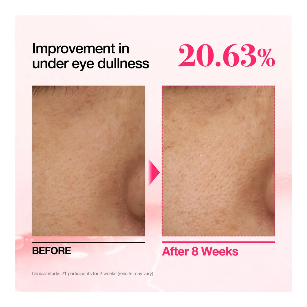Before and after under-eye close-ups showing a 20.63% improvement in under-eye dullness after eight weeks