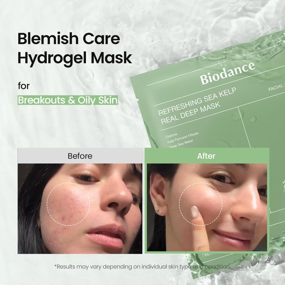 Refreshing Sea Kelp mask pack with before and after cheek photos, a blemish-care hydrogel mask for breakouts and oily skin