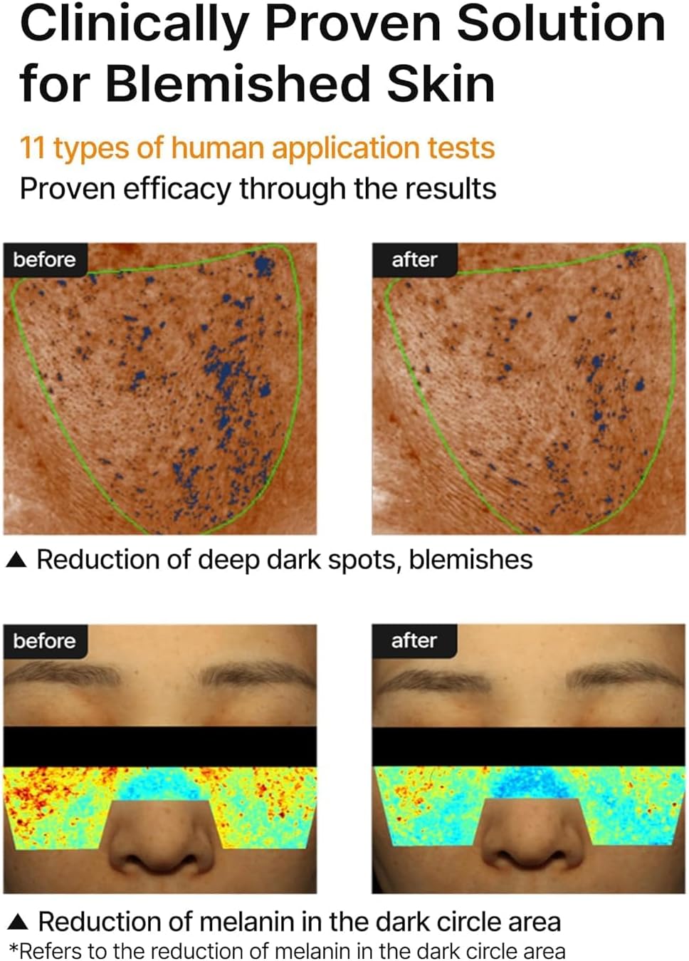 Clinically proven solution for blemished skin: before and after images showing reduced deep dark spots and reduced melanin in the dark circle area