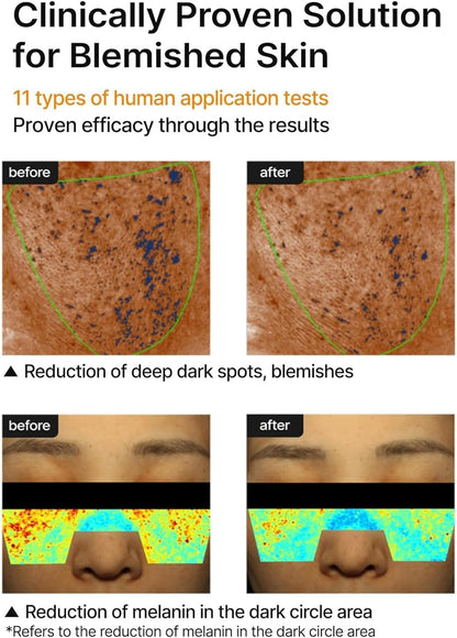 Clinically proven solution for blemished skin: before and after images showing reduced deep dark spots and reduced melanin in the dark circle area