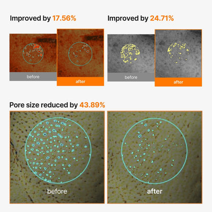 Before and after skin images: improvements of 17.56% and 24.71%, and pore size reduced 43.89%