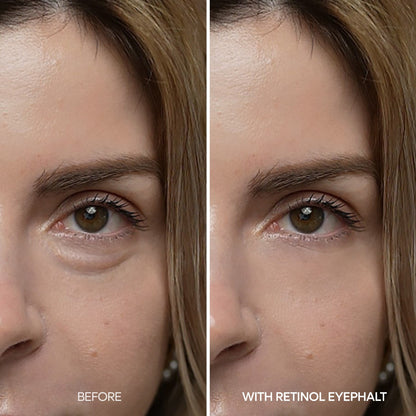 Dr.Melaxin Eyephalt Retinol Eyebag Cream 10g before and after on a model's under-eye, showing smoother-looking eye bags