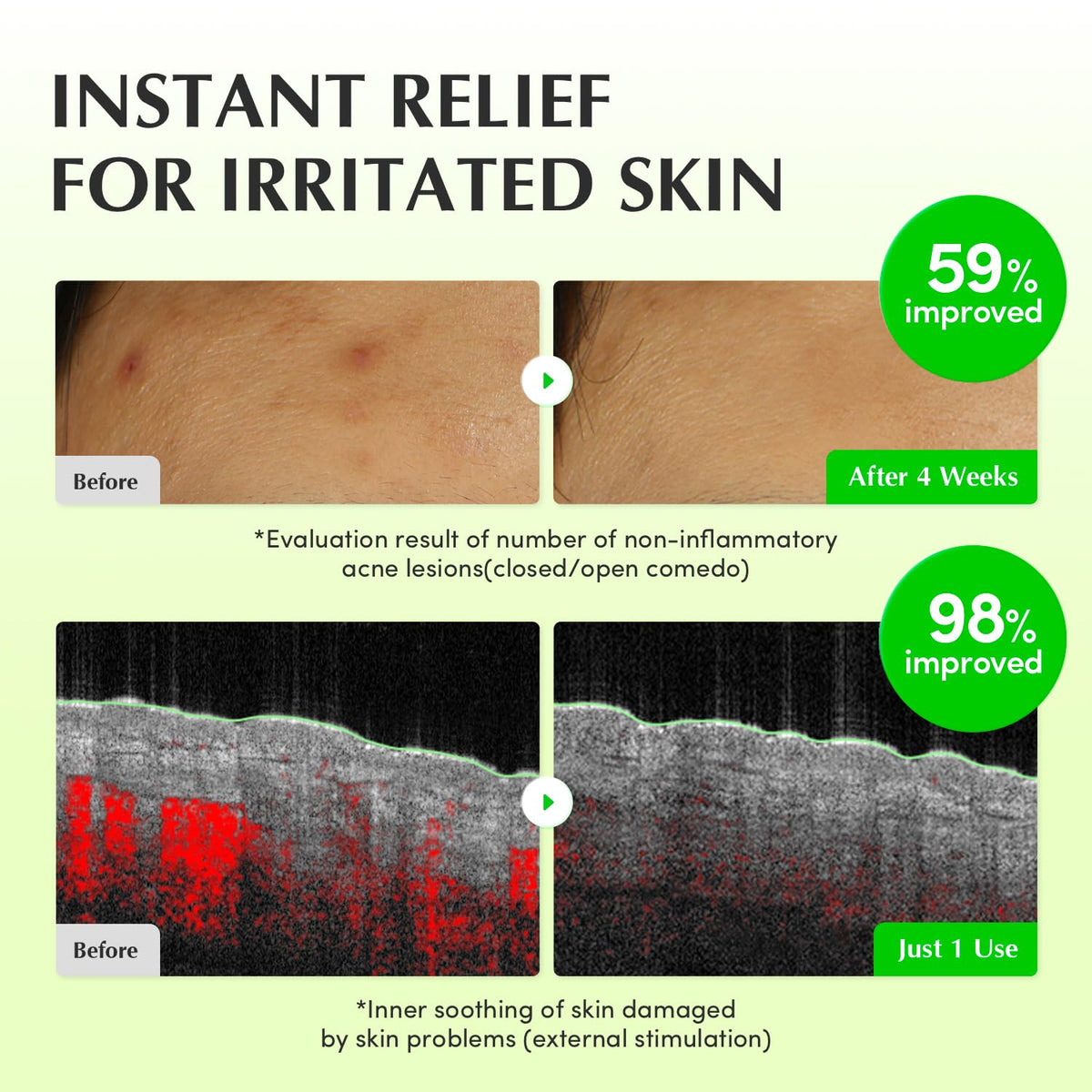 Instant relief for irritated skin: before and after images with non-inflammatory acne improved 59% after four weeks and inner soothing improved 98% after one use