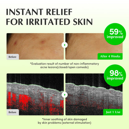 Instant relief for irritated skin: before and after images with non-inflammatory acne improved 59% after four weeks and inner soothing improved 98% after one use