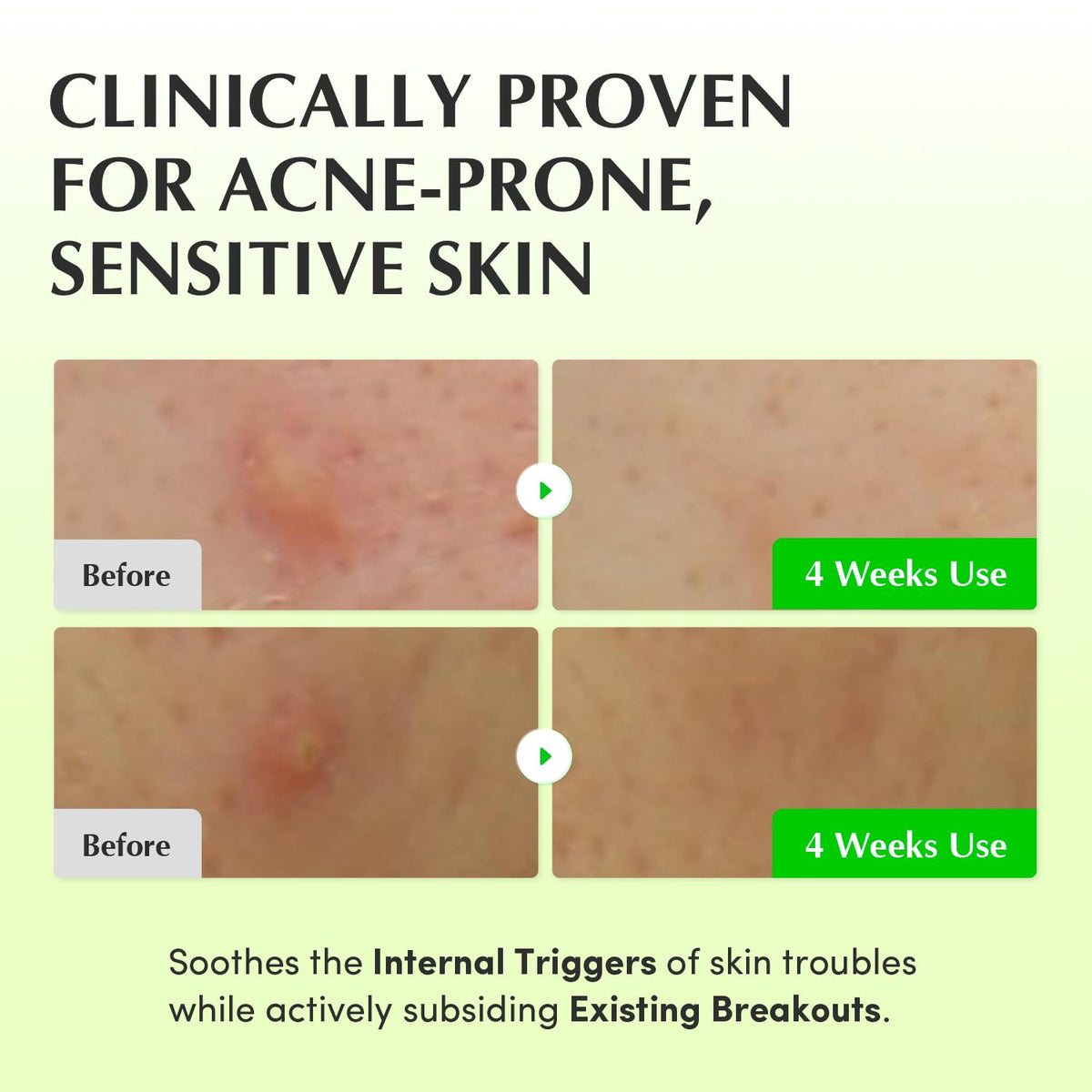 Clinically proven for acne-prone, sensitive skin: two before and after cheek photos at four weeks, soothing internal triggers while subsiding breakouts
