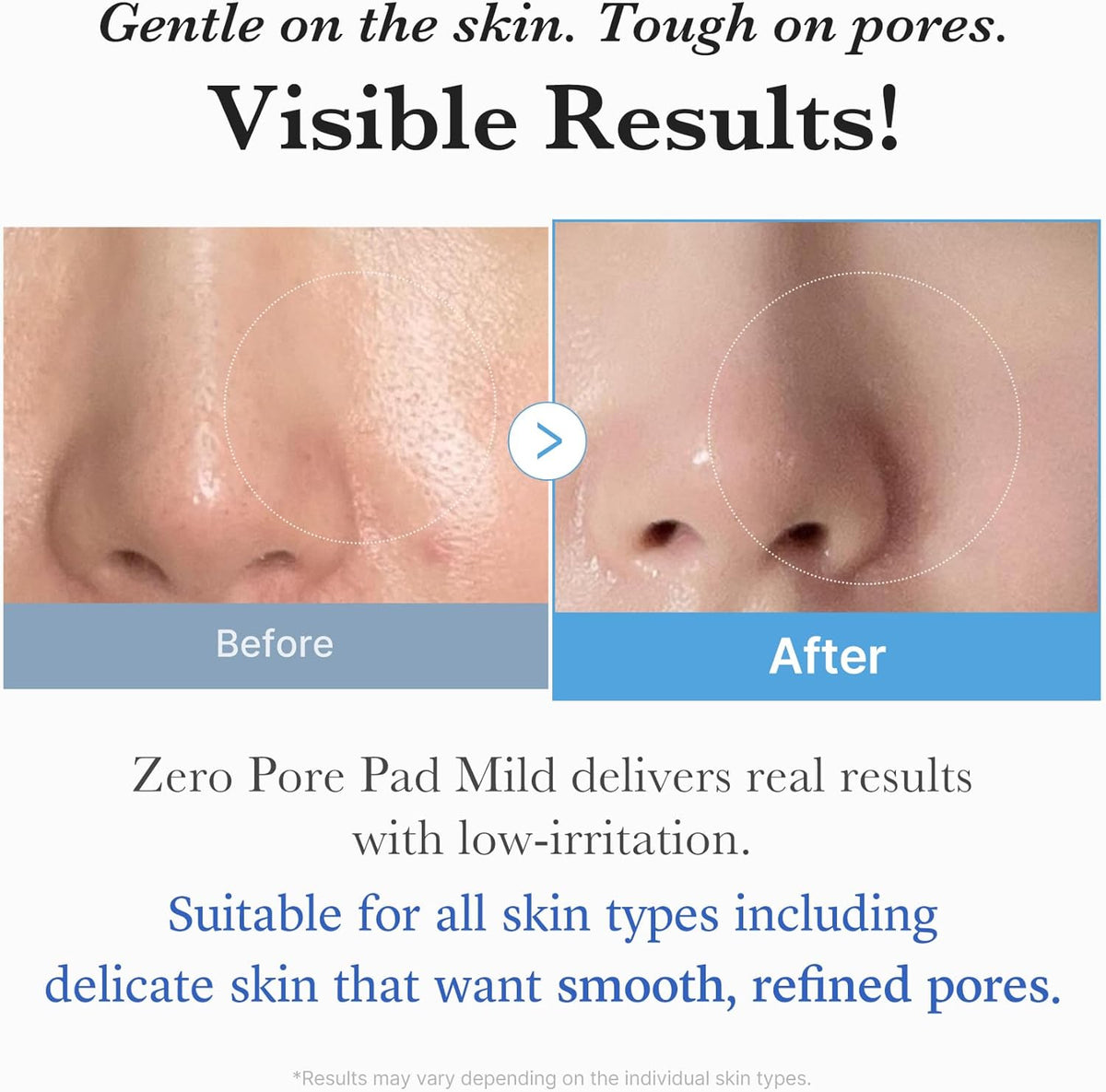 Gentle on the skin, tough on pores: before and after nose close-ups showing visible results with low irritation