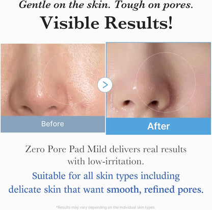 Gentle on the skin, tough on pores: before and after nose close-ups showing visible results with low irritation
