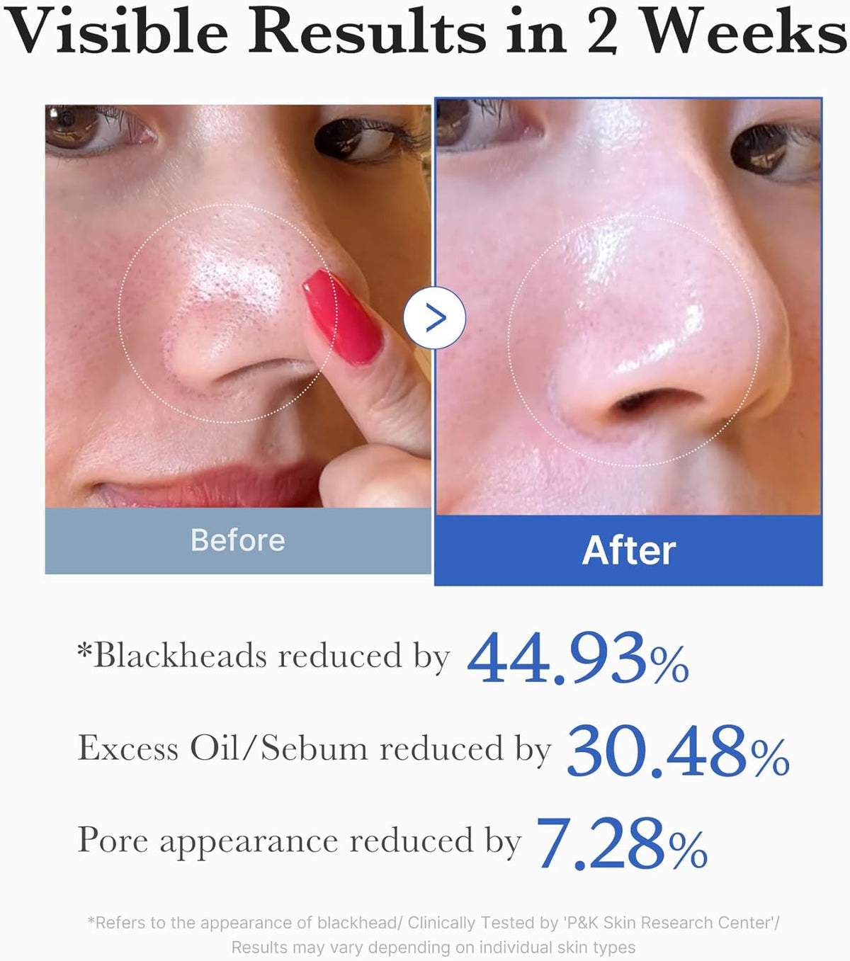 Before and after close-ups of a nose after two weeks: blackheads reduced 44.93%, excess oil and sebum reduced 30.48%, pore appearance reduced 7.28%