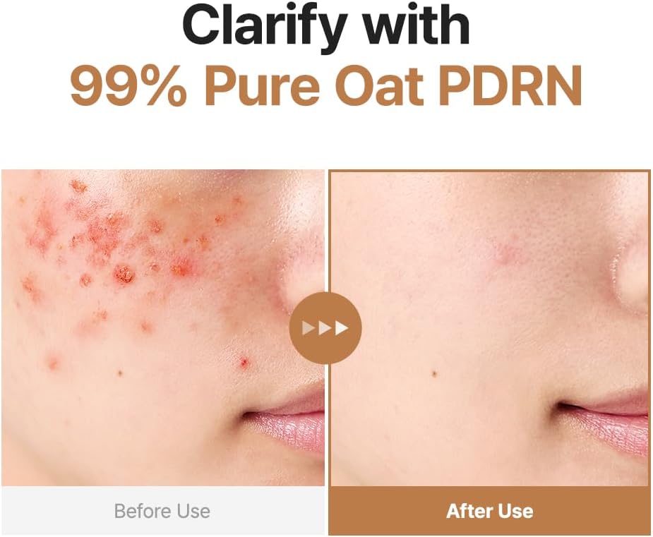 Clarify with 99% pure oat PDRN: before and after cheek photos showing blemishes visibly reduced