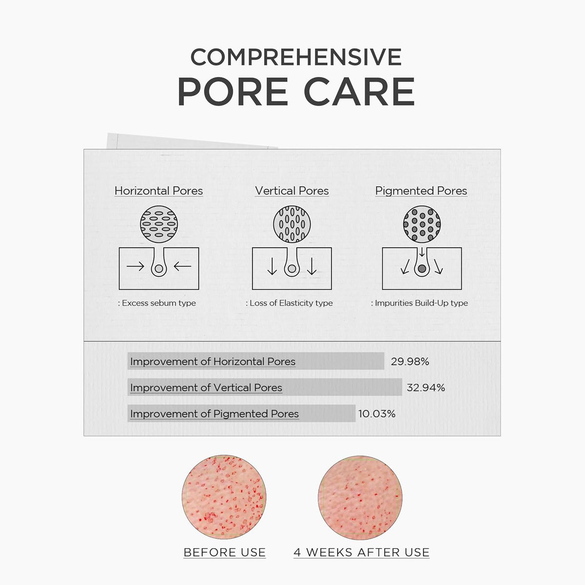Comprehensive pore care: horizontal pores improved 29.98%, vertical pores 32.94%, pigmented pores 10.03% after four weeks