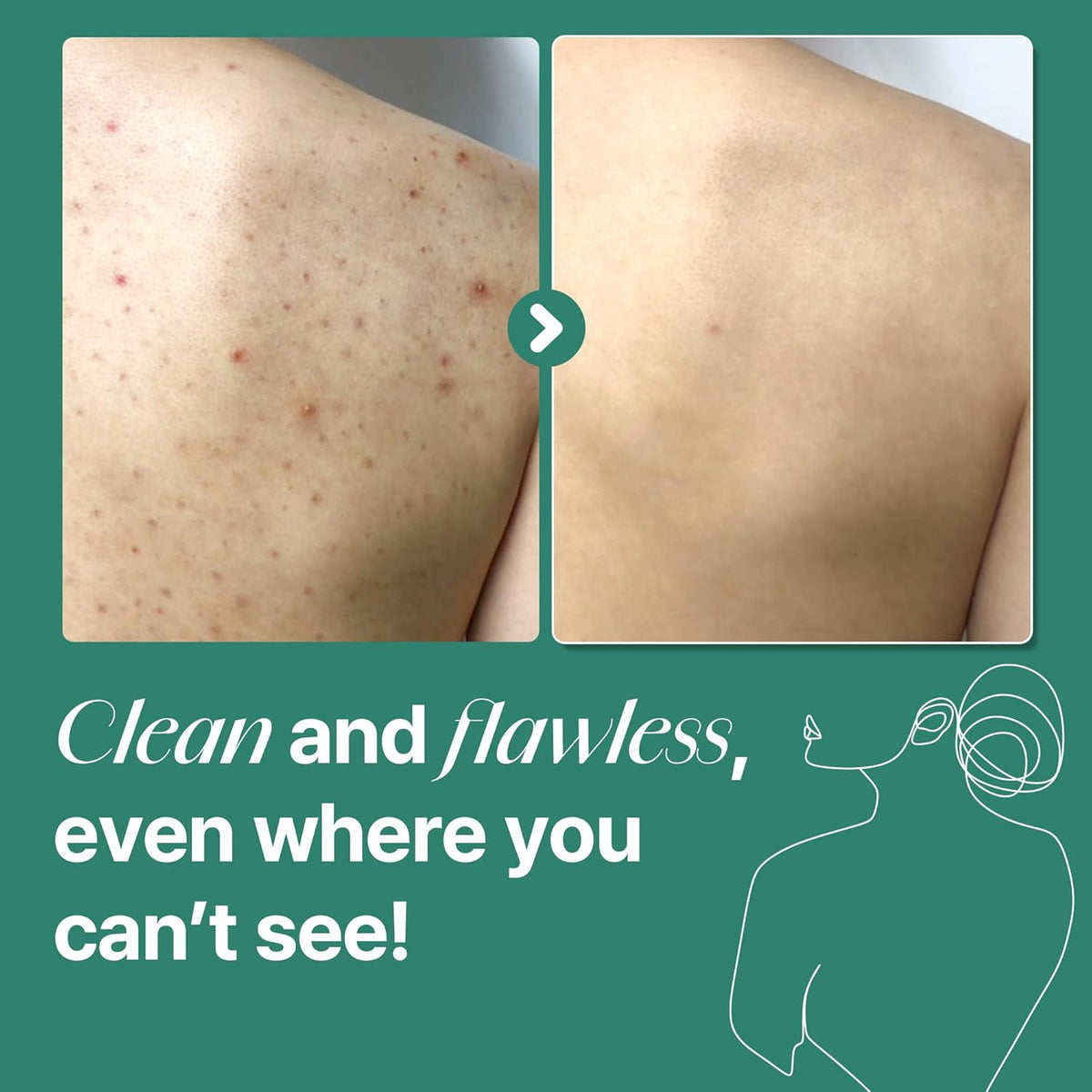 Clean and flawless even where you can't see: before and after photos of a shoulder with blemishes