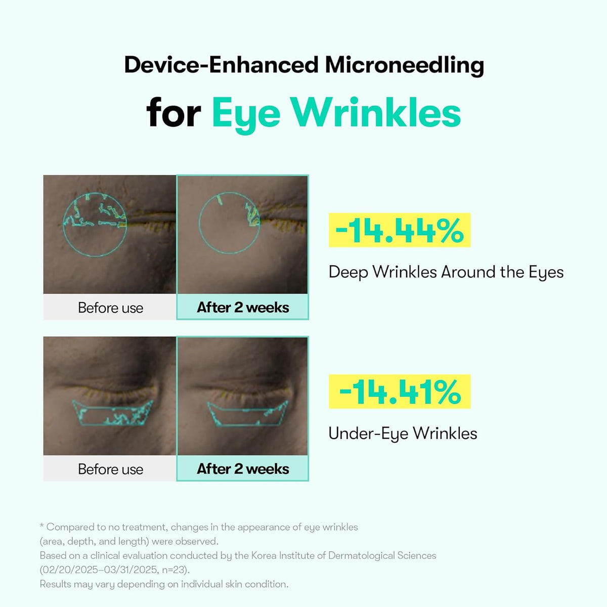 Device-enhanced microneedling for eye wrinkles: before and after eye images, deep wrinkles down 14.44% and under-eye wrinkles down 14.41% after two weeks